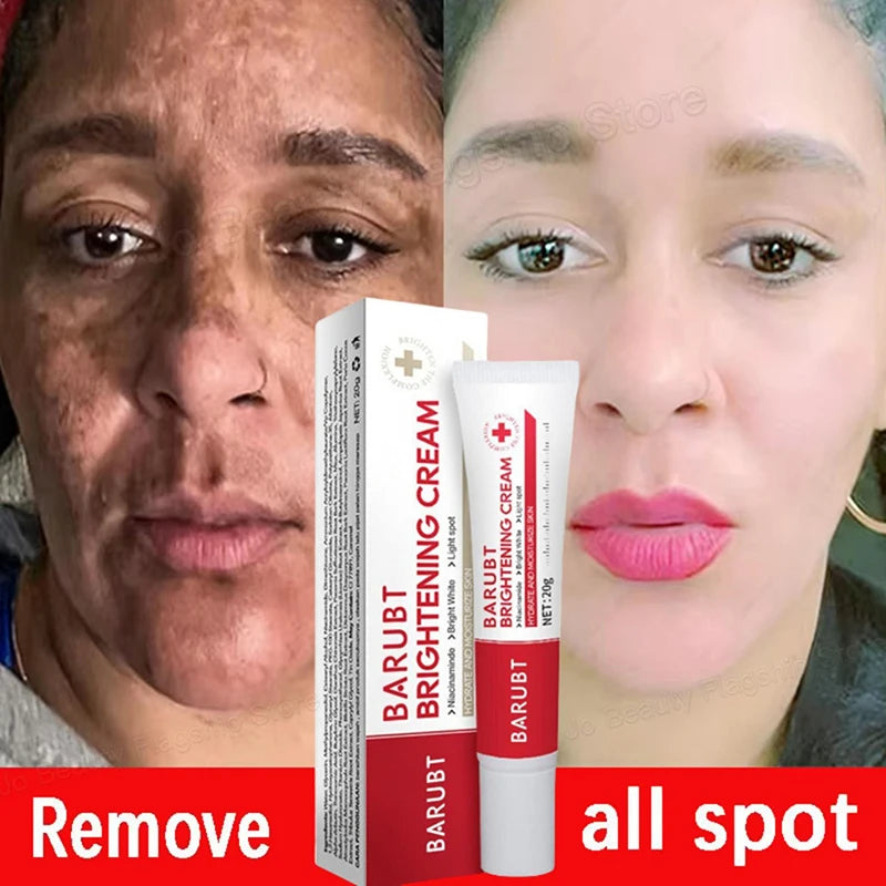 Whitening Freckles Face Cream Removal Melasma