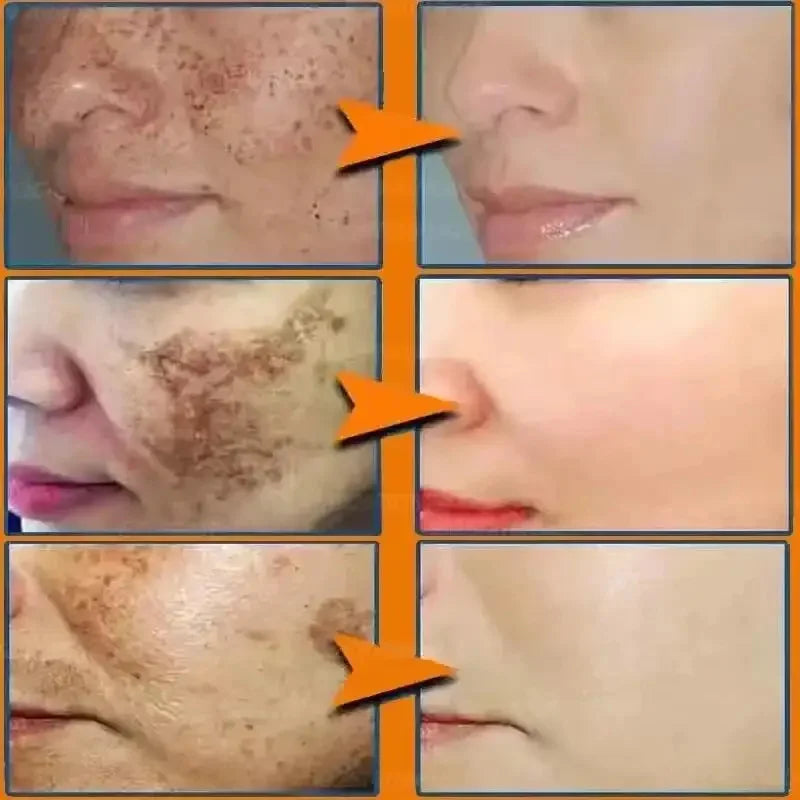 Whitening Freckles Face Cream Removal Melasma