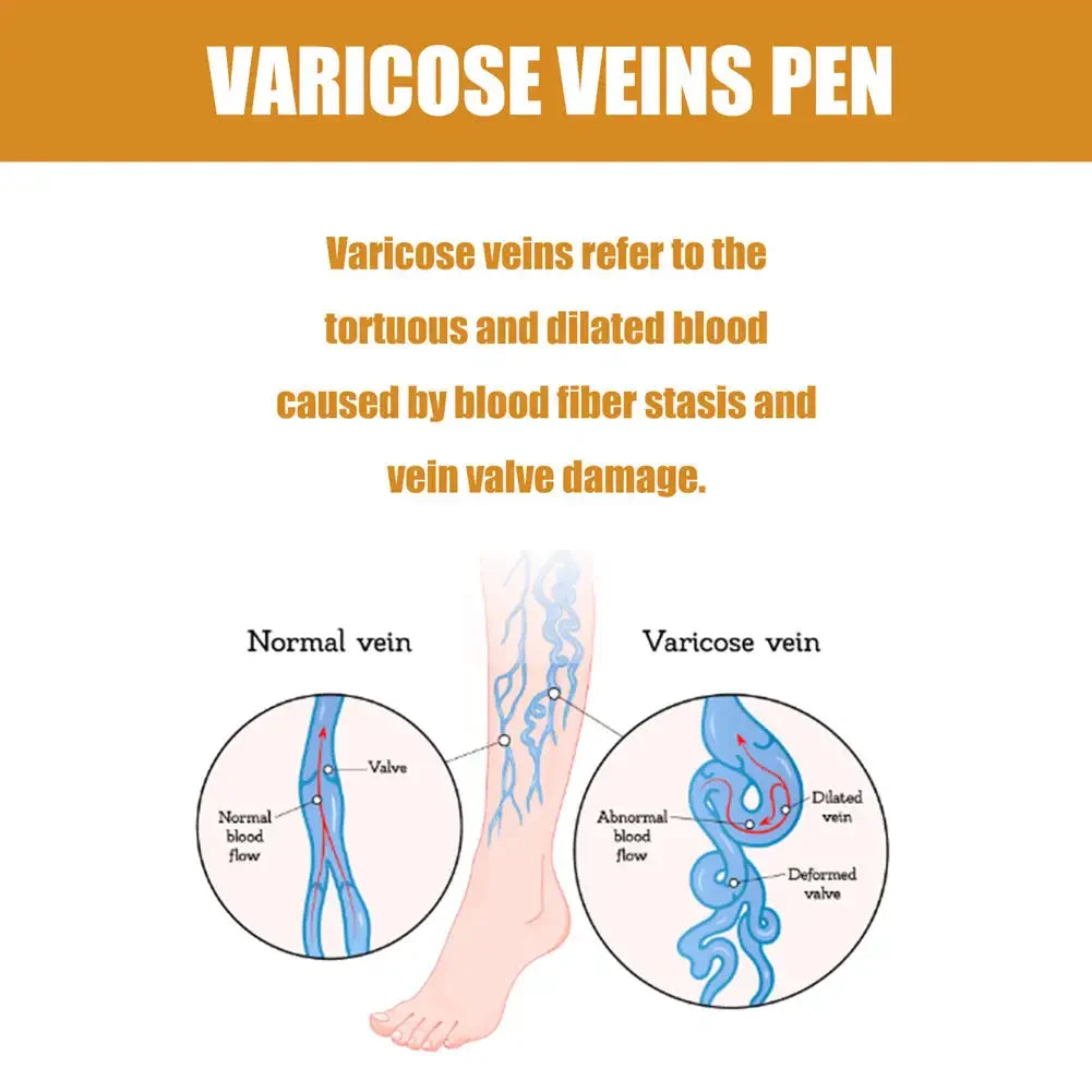 Varicose Vens Pen Repair Vasculitis Phlebitis Soothe Skin Relieve Varicose Feet Blood Vessel Blockage Body Health Care