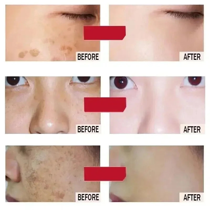 Whitening Freckles Face Cream Removal Melasma