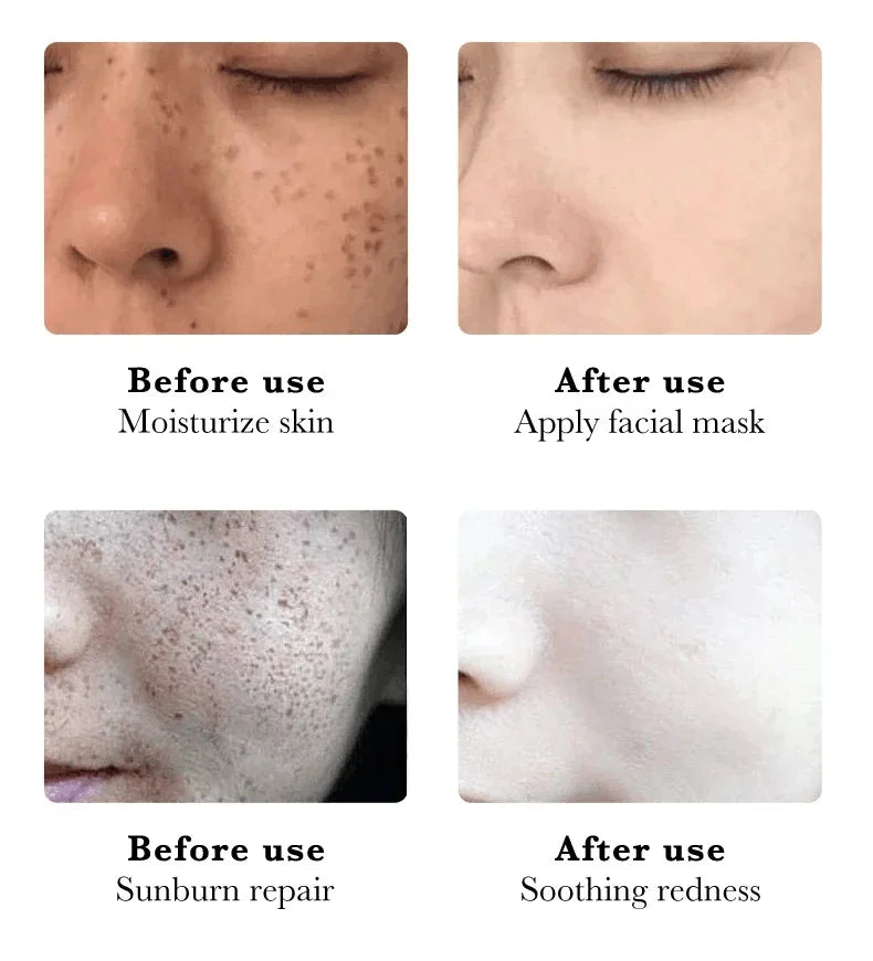 Whitening Freckles Face Cream Removal Melasma