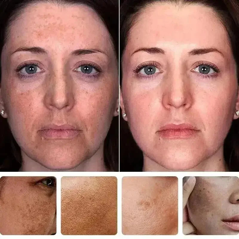 Whitening Freckles Face Cream Removal Melasma