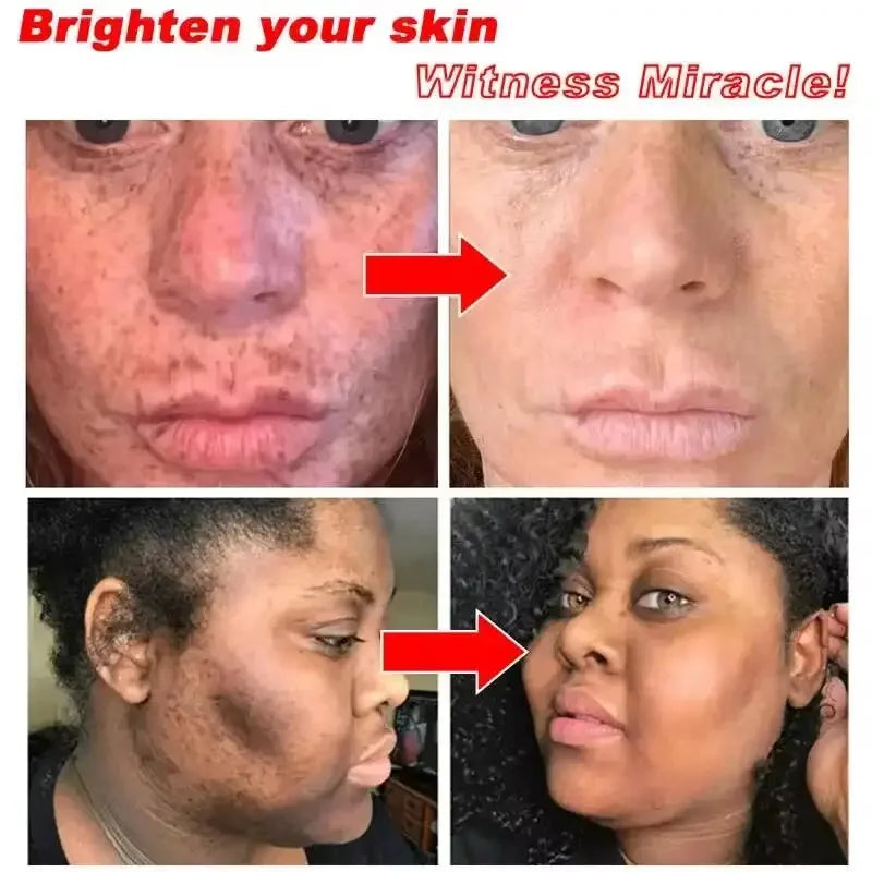 Whitening Freckles Face Cream Removal Melasma