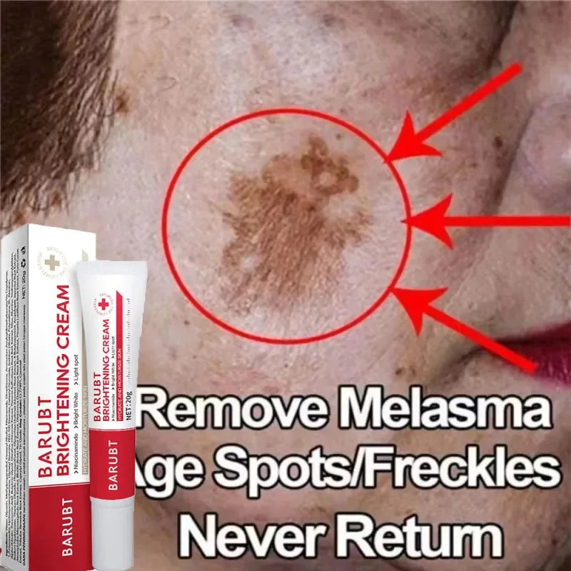 Whitening Freckles Face Cream Removal Melasma