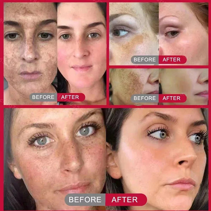 Whitening Freckles Face Cream Removal Melasma